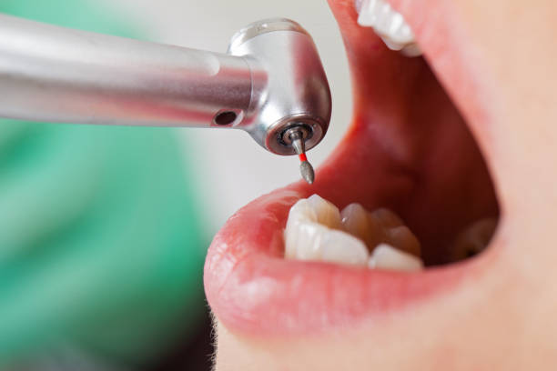 Best Emergency Dentist for Lost Fillings or Crowns in Union City, MI